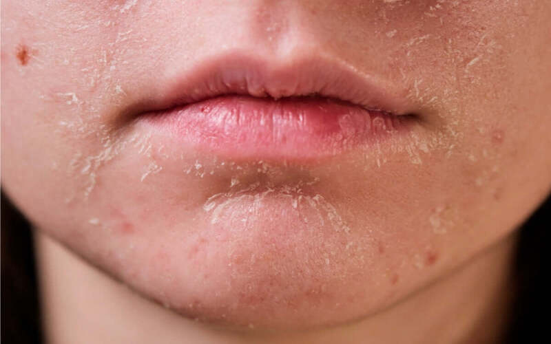 Tình trạng khô ráp da thường xuất hiện là những dấu hiệu sau khi phi kim