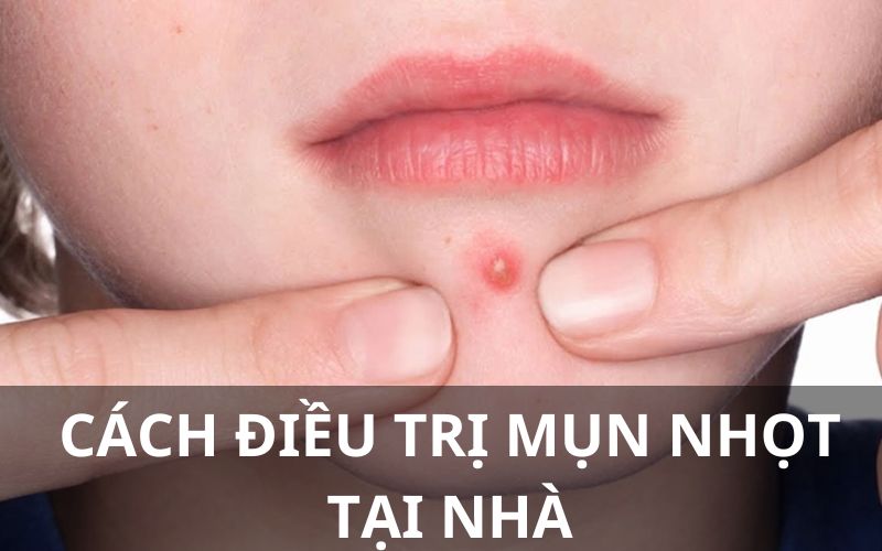 Cách trị mụn nhọt