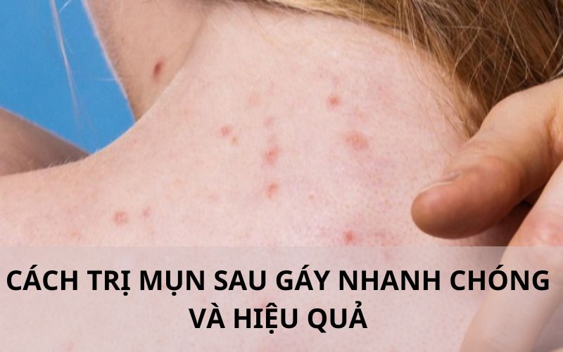 Cách trị mụn sau gáy an toàn