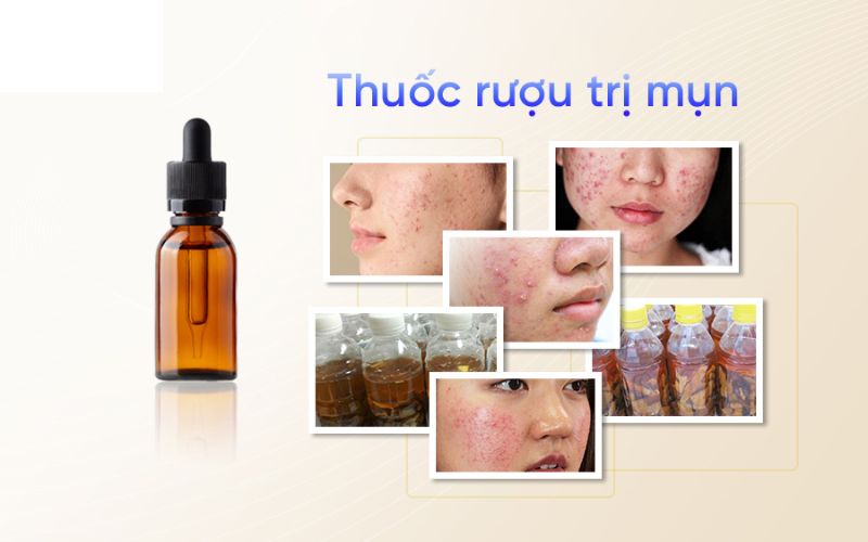 Dùng rượu thuốc trị mụn có tốt không?