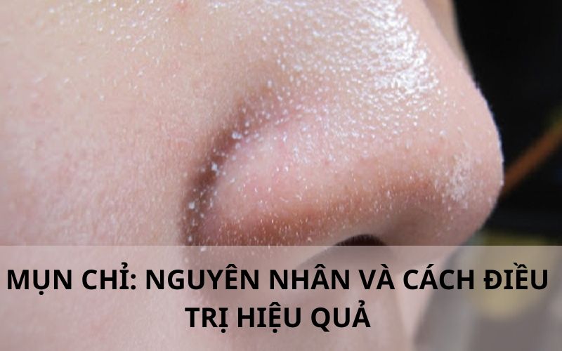 Nguyên nhân cách điều trị mụn chỉ