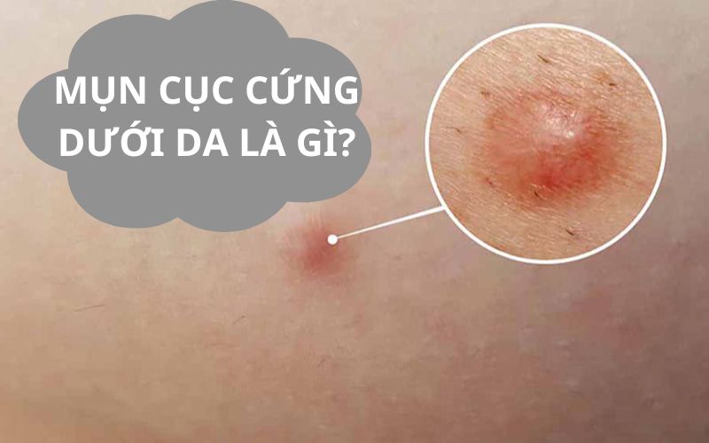 Mụn cục cứng dưới da