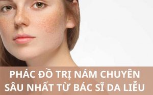 Phác đồ điều trị nám chuẩn y khoa