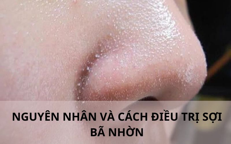 Nguyên nhân và cách điều trị sợi bã nhờn