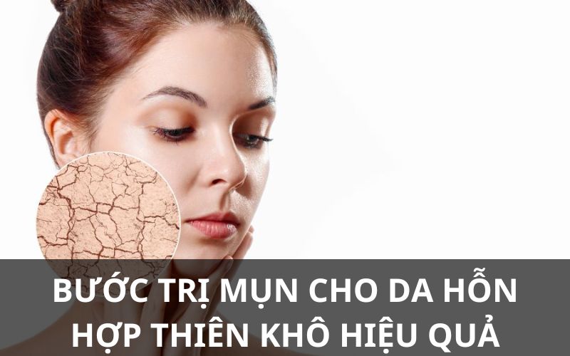 trị mụn cho da hỗn hợp thiên khô