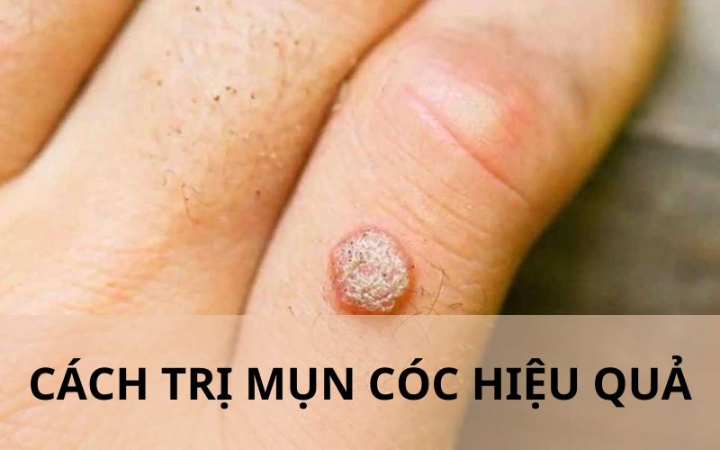 Cách trịn mụn cóc hiệu quả