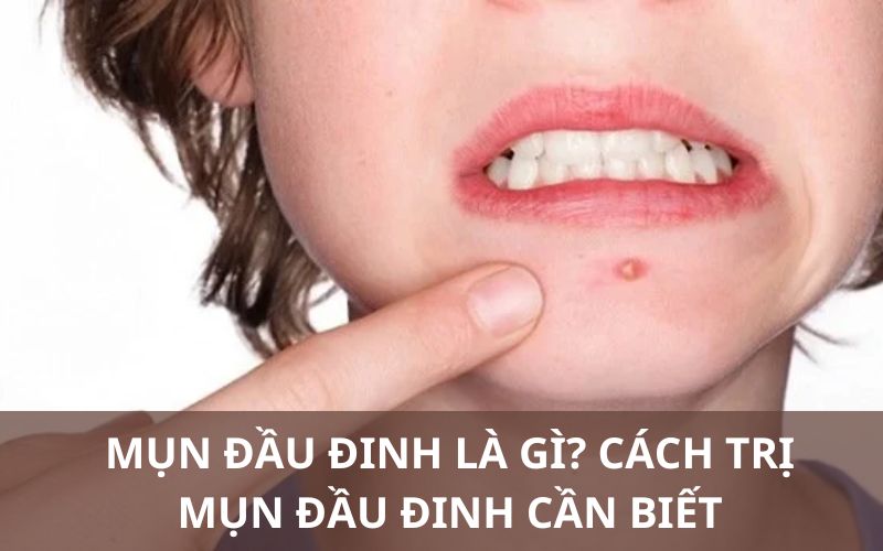 Cách trị mụn đầu đinh