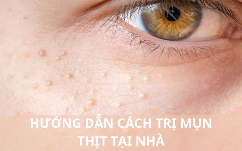 Cách trị mụn thịt