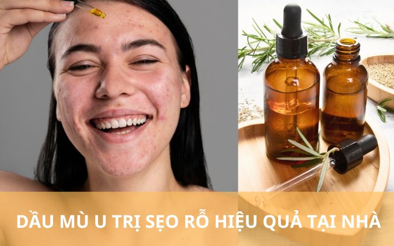 Dầu mù u trị sẹo hiệu quả