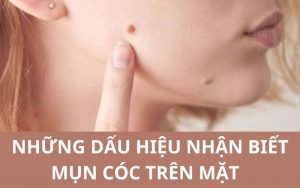 Mụn cóc trên mặt