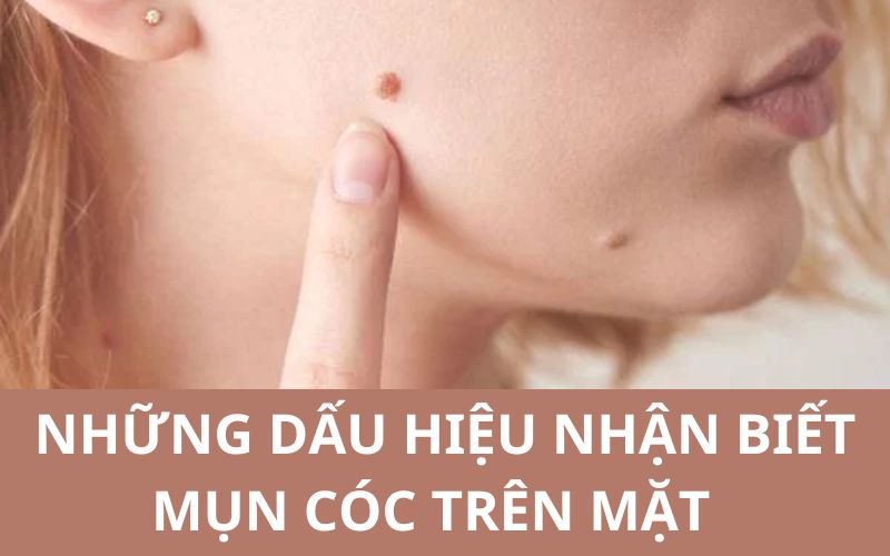 Mụn cóc trên mặt