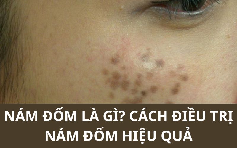 Nám đốm là gì