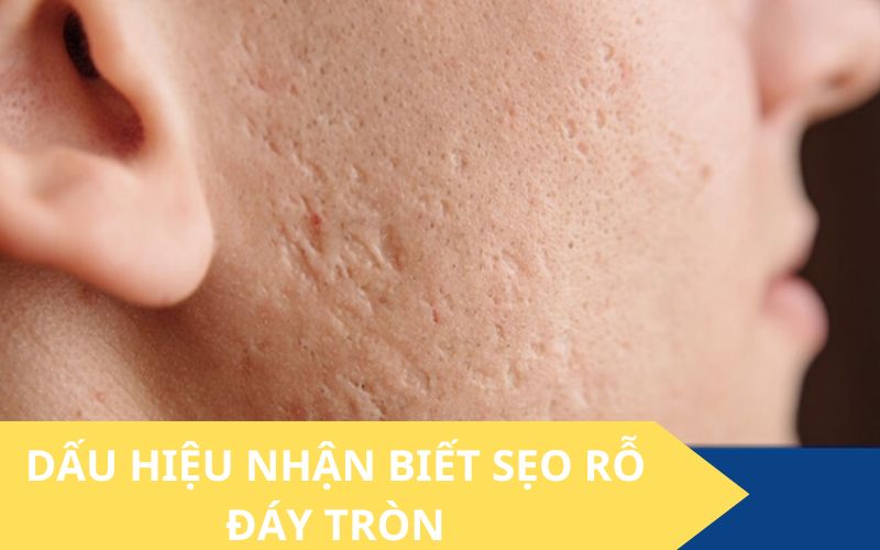 Sẹo rỗ đấy tròn là gì?