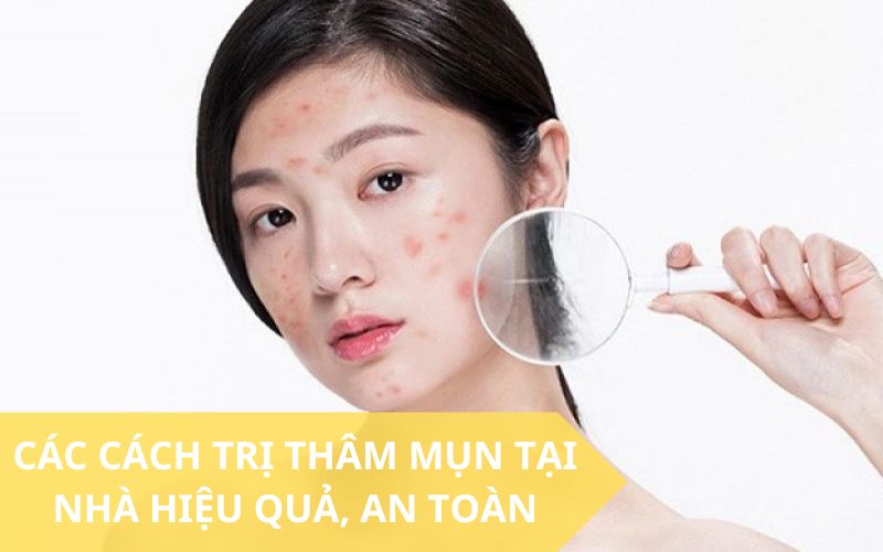 Cách trị thâm mụn